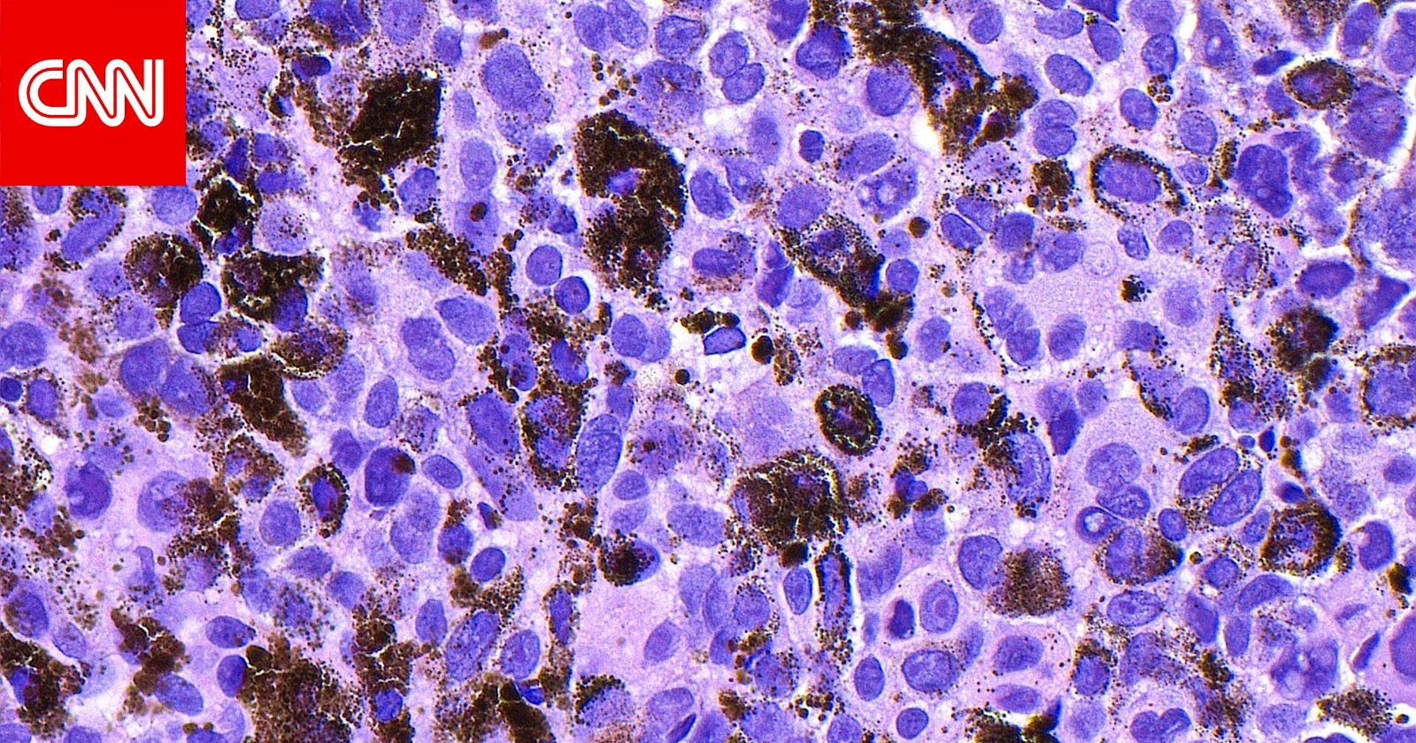 نجاح تجربة متقدّمة للقاح mRNA ضدّ أخطر أنواع سرطان الجلد